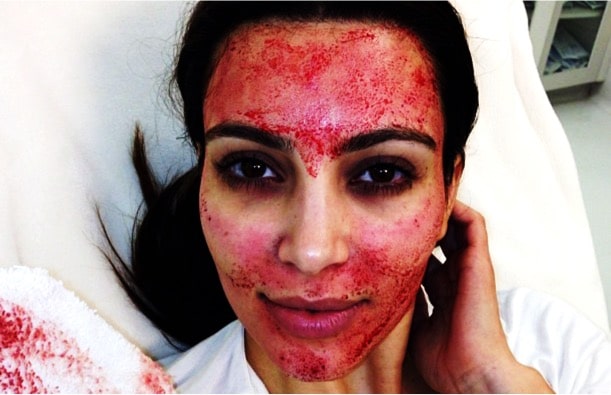 vampire facial 2018 kim kardashian