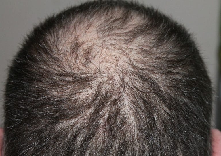 male pattern baldness